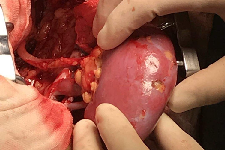 肾移植手术图 肾移植手术图