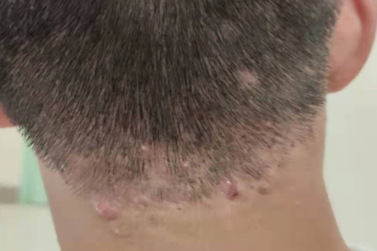 项部瘢痕疙瘩性毛囊炎图