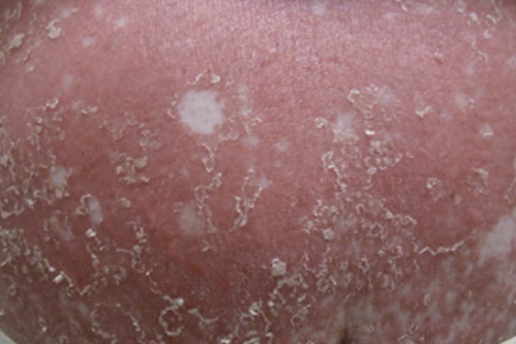 毛发红糠疹性红皮病腹部红斑图