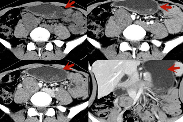平滑肌肉瘤影像图 平滑肌肉瘤影像图
