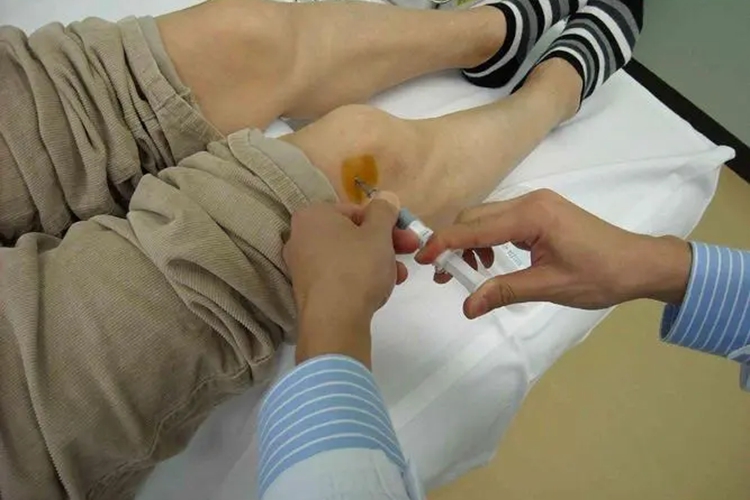 膝关节腔注射图 膝关节腔注射图