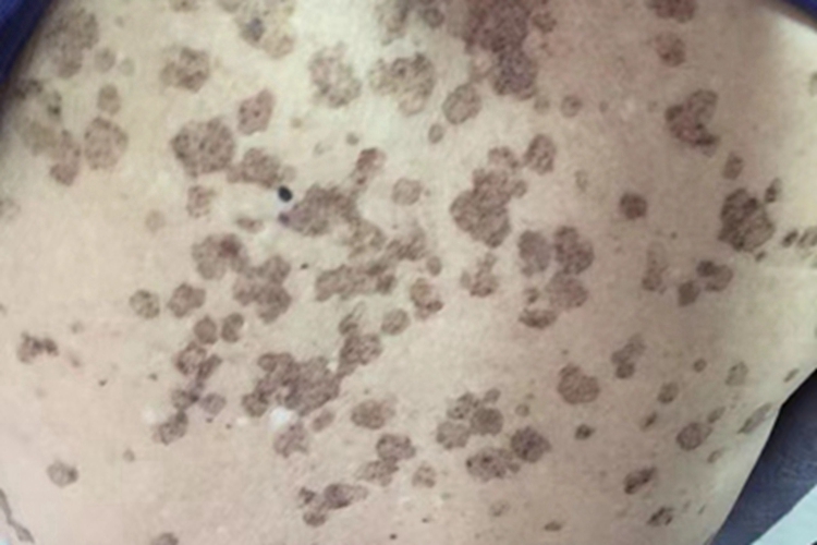 汗孔角化症腹部黑斑图 汗孔角化症腹部黑斑图