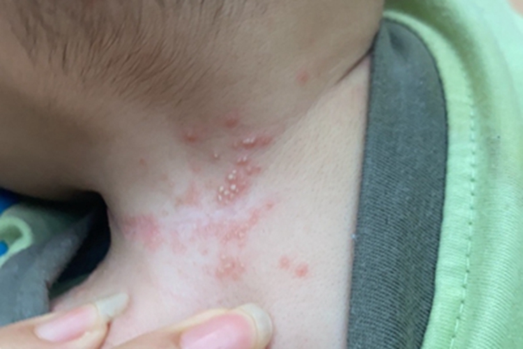 痱子侧颈小红疙瘩图 痱子侧颈小红疙瘩图