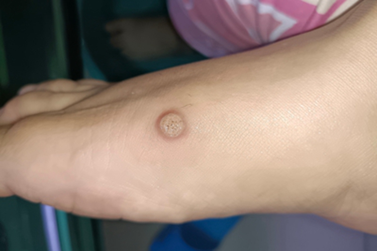 寻常疣脚部症状图 寻常疣脚部症状图