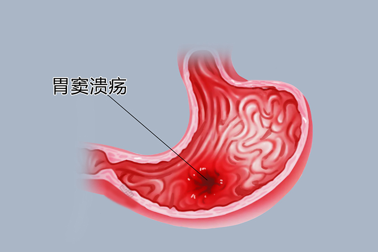胃窦溃疡图片图片