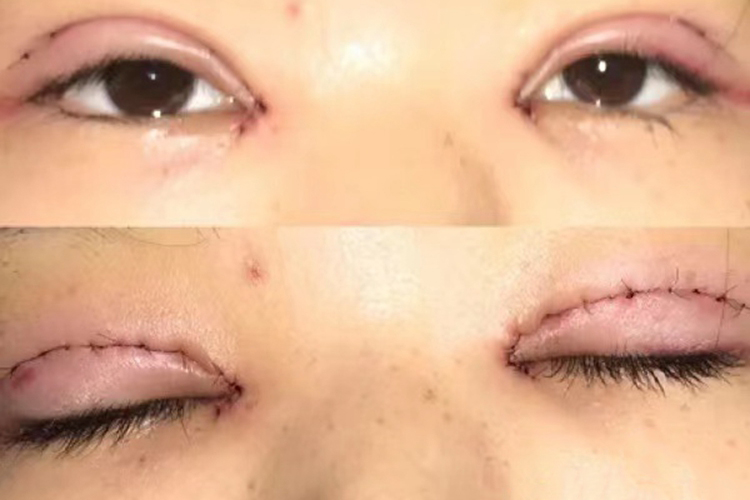 全切双眼皮第五天图