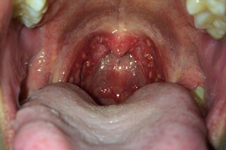 扁桃体隐窝部位结石图