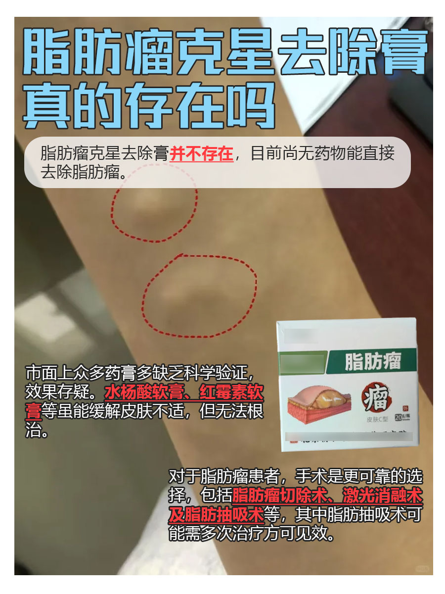 脂肪瘤去除膏，能否终结烦恼？真相在这里