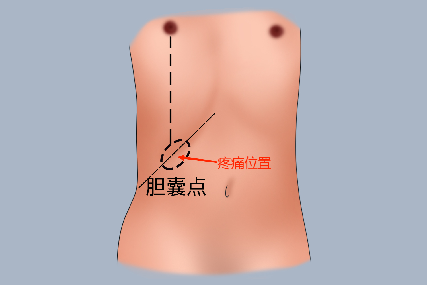 胆囊炎肋骨疼痛位置图