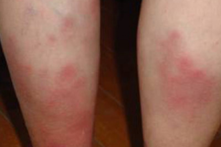 贝赫切特综合征小腿长暗红斑图