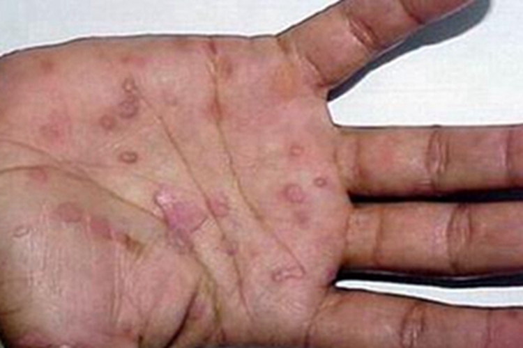 扁平湿疣手掌症状图