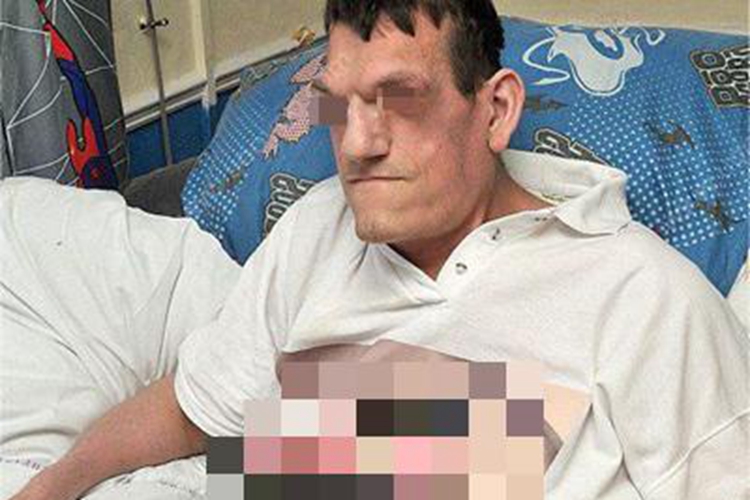 巨人症面部变形图 巨人症面部变形图