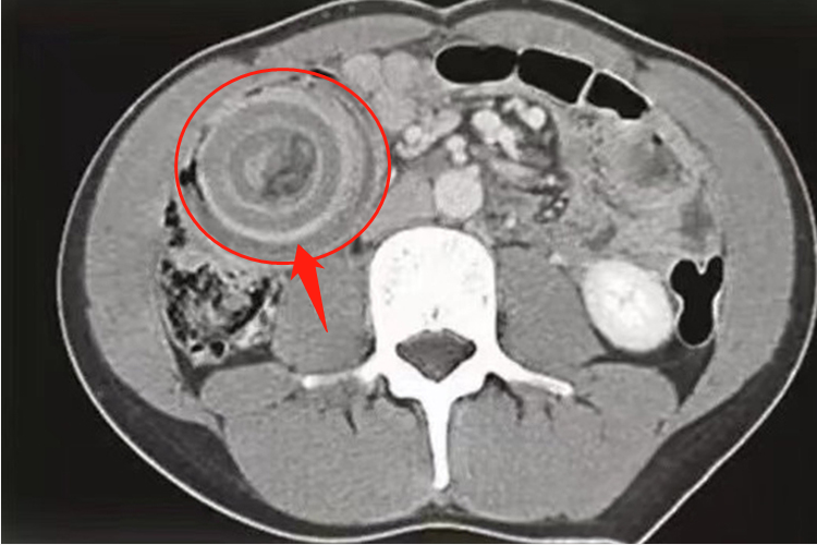 典型靶形肠套叠CT图
