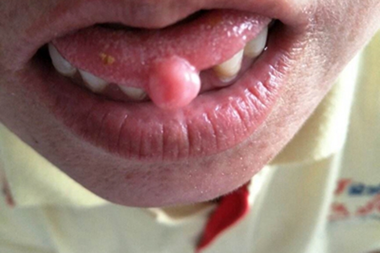 舌癌舌尖有一圆形囊肿图
