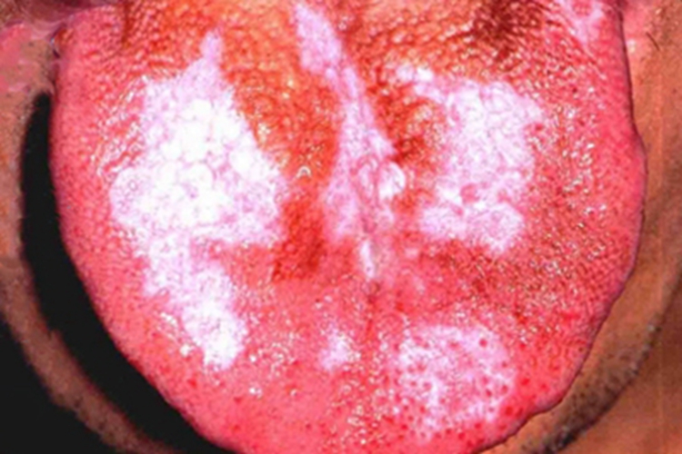 舌扁平苔藓舌头症状图 舌扁平苔藓舌头症状图