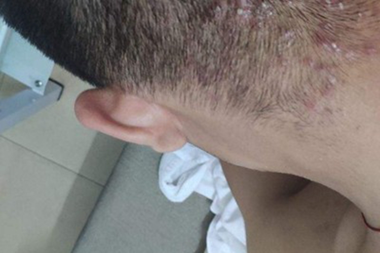 项部瘢痕疙瘩性毛囊炎头皮脓包图 项部瘢痕疙瘩性毛囊炎头皮脓包图