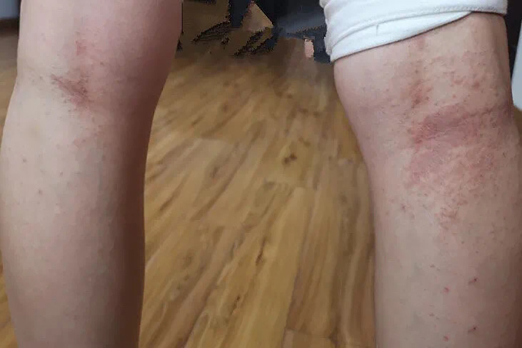 慢性湿疹皮肤发红粗糙图