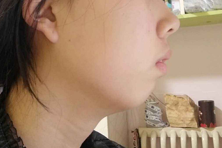 鼻炎导致下巴后缩图