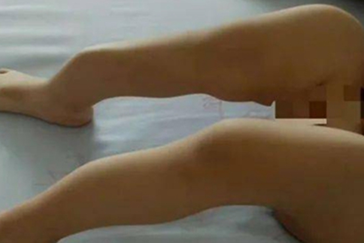 成骨不全腿症状图