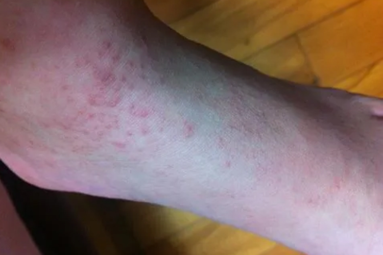 虫咬反应图 虫咬反应图