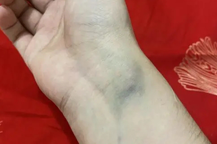 过敏性紫癜手腕内侧淤青图 过敏性紫癜手腕内侧淤青图