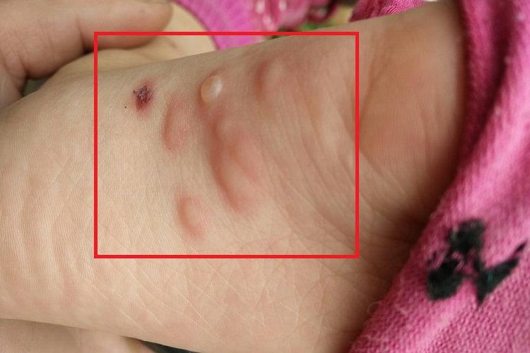 水痘脚底结痂图 水痘脚底结痂图