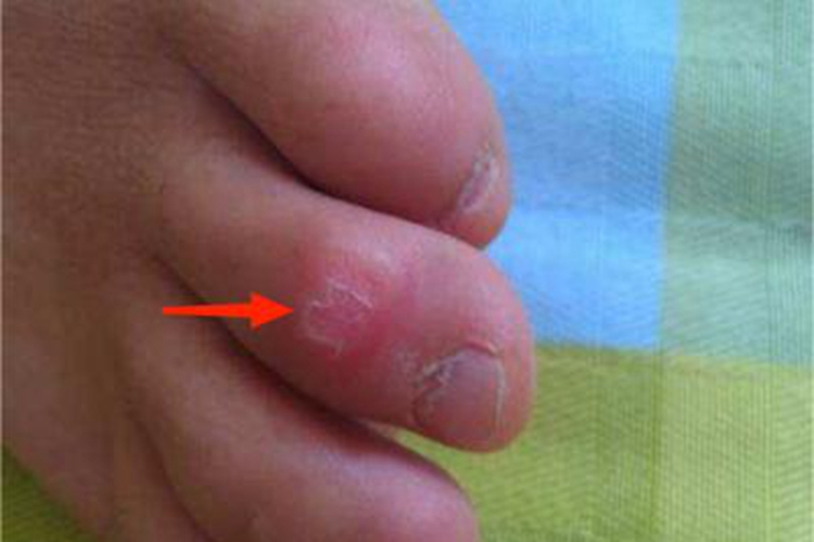 脚趾长水疱红肿掉皮图 脚趾长水疱红肿掉皮图