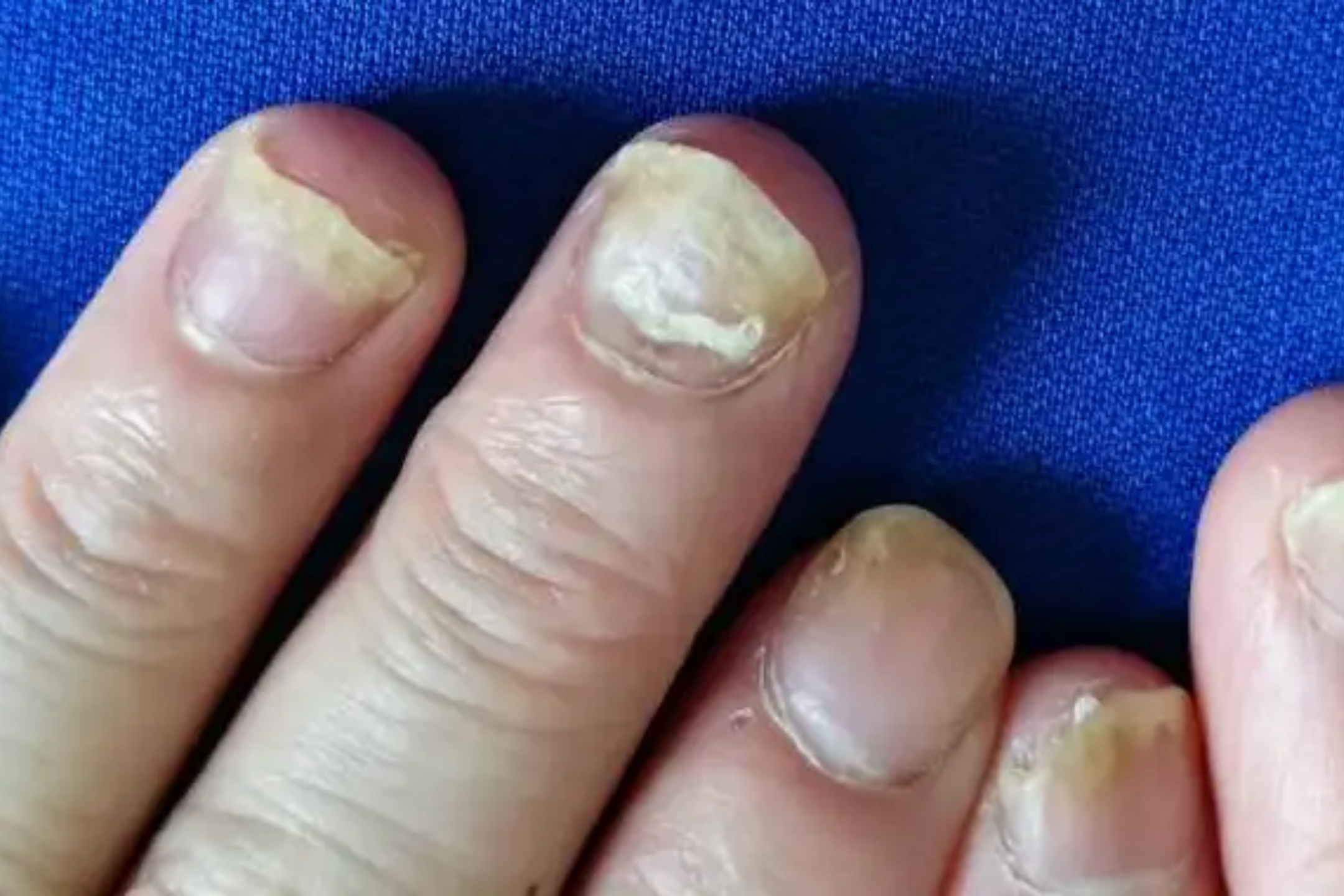 甲银屑病甲母质受损图