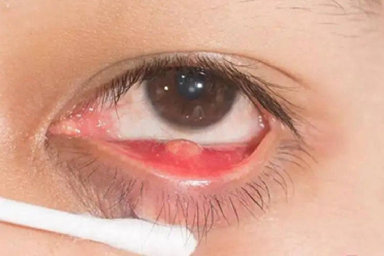 内睑腺炎眼睑红肿图