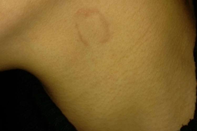 局限型环状肉芽肿侧颈长斑图 局限型环状肉芽肿侧颈长斑图