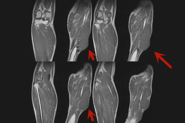 小腿平滑肌肉瘤影像图 小腿平滑肌肉瘤影像图