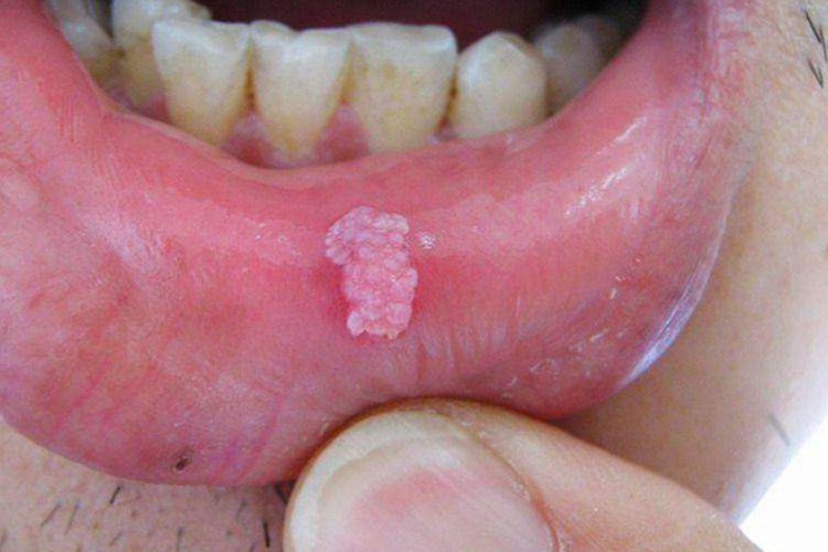 唇部尖锐湿疣图 唇部尖锐湿疣图