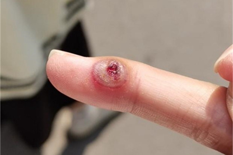 化脓性肉芽肿手指水疱图