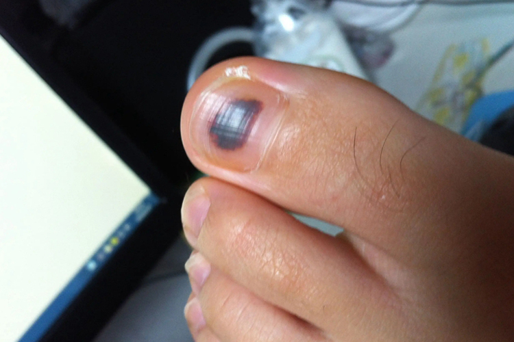 脚趾甲淤血发黑图