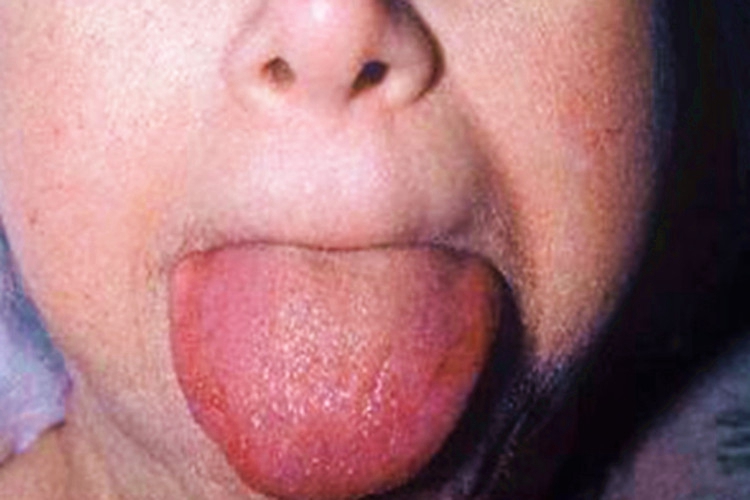 黏液性水肿舌头肿图