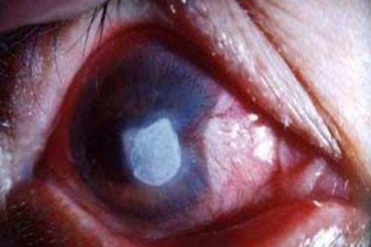 棘阿米巴角膜炎眼部白斑图 棘阿米巴角膜炎眼部白斑图