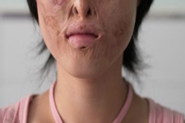 小口畸形口周有瘢痕图