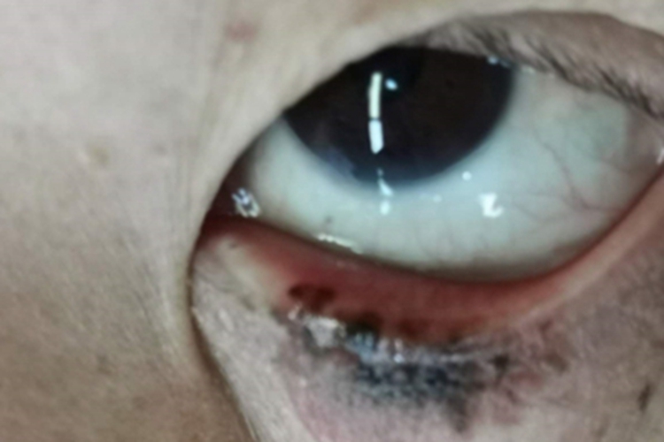 眼睑恶性黑色素瘤黑斑图 眼睑恶性黑色素瘤黑斑图