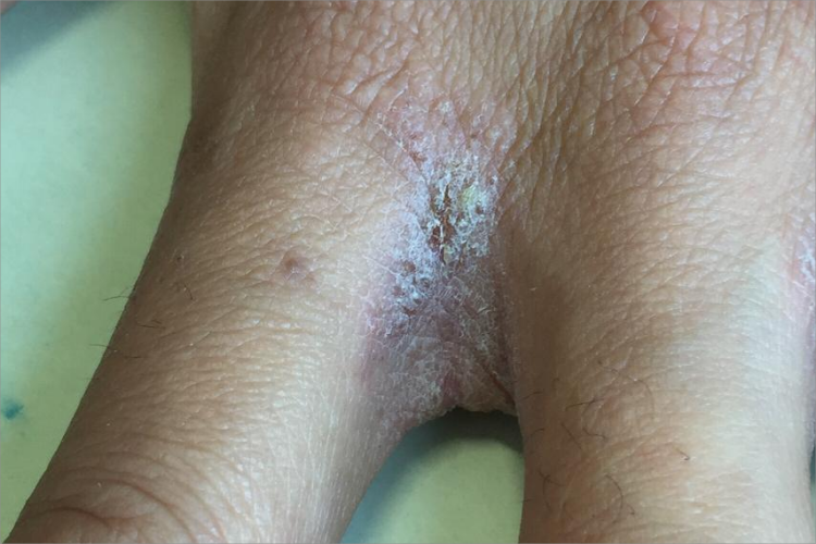 结痂性疥疮皮肤增厚图