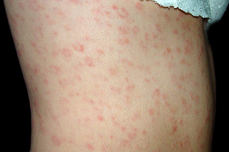 梅毒疹早期红点斑疹图