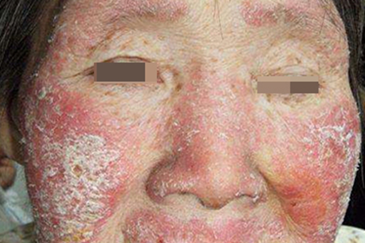 红斑型天疱疮面部红斑图