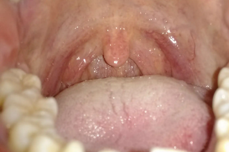 正常嗓子图 正常嗓子图