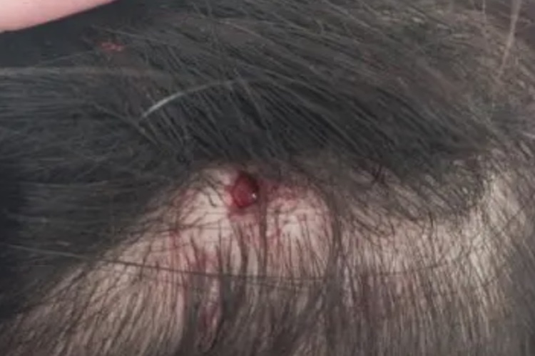 婴儿头皮出血点图