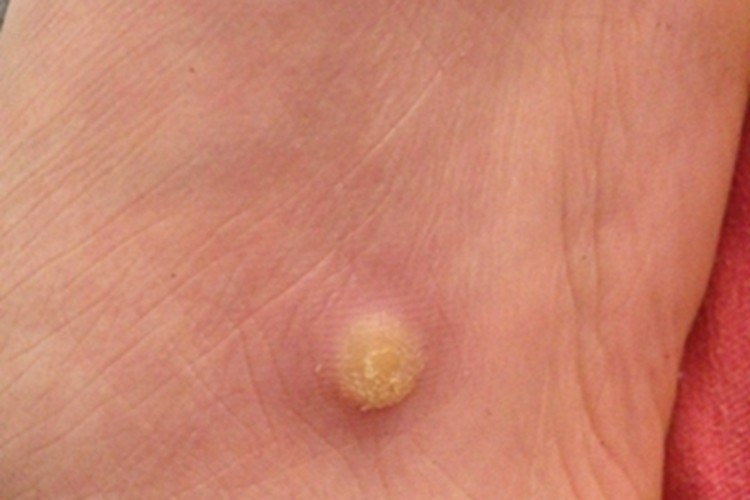 职业性疣赘脚底结节图