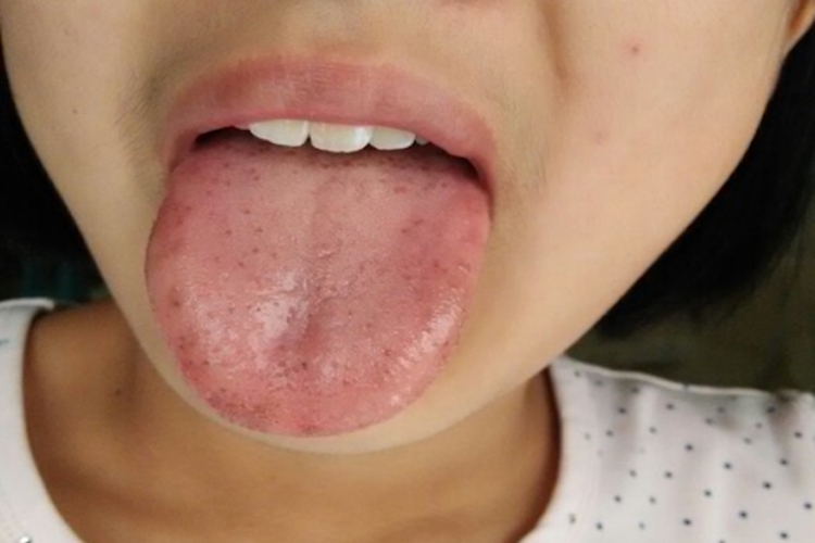 舌头边缘有黑斑是肝病图片