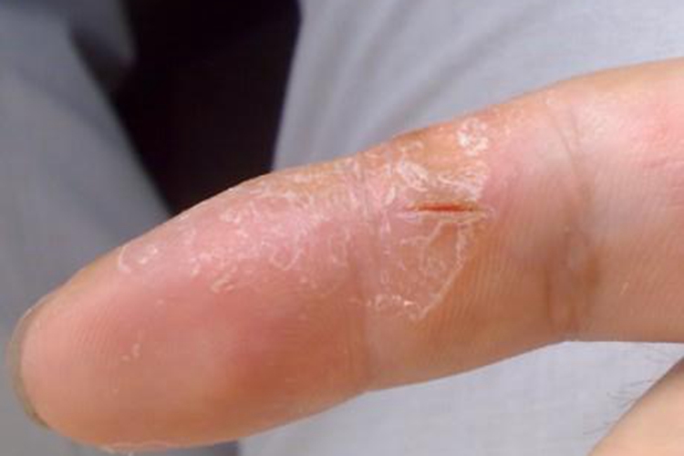 甲状腺功能减退症手指症状图 甲状腺功能减退症手指症状图