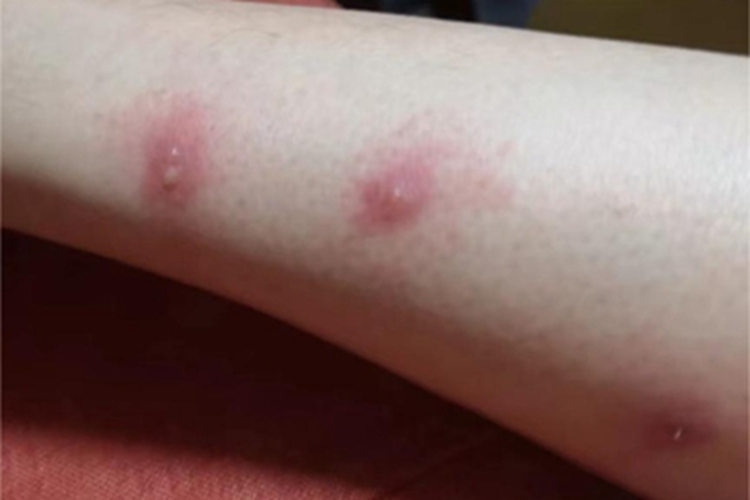 虫咬皮炎小腿小水疱图 虫咬皮炎小腿小水疱图