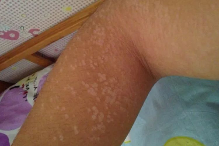 白色糠疹图 白色糠疹图