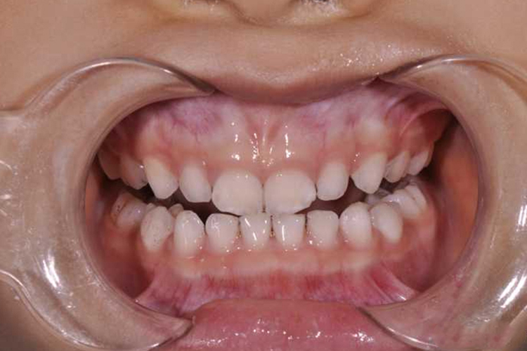 三岁宝宝牙齿钙化图