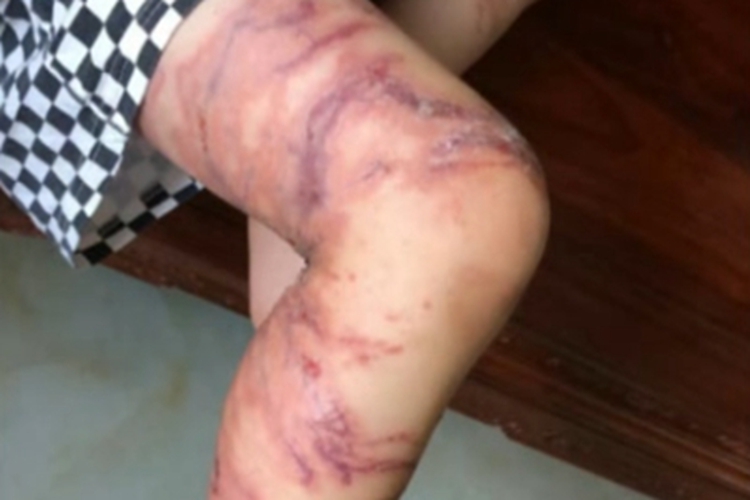 海蜇蜇伤腿上出现溃烂图